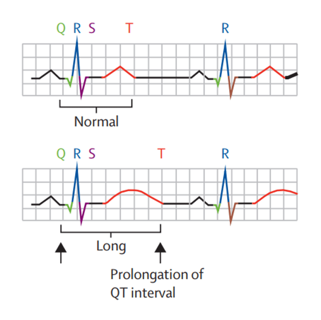 Drug prolongation of the QT interval of an ECG
